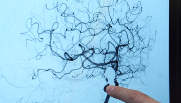 Doktorlar uyardı, her 20 kişiden 1’inde görülüyor